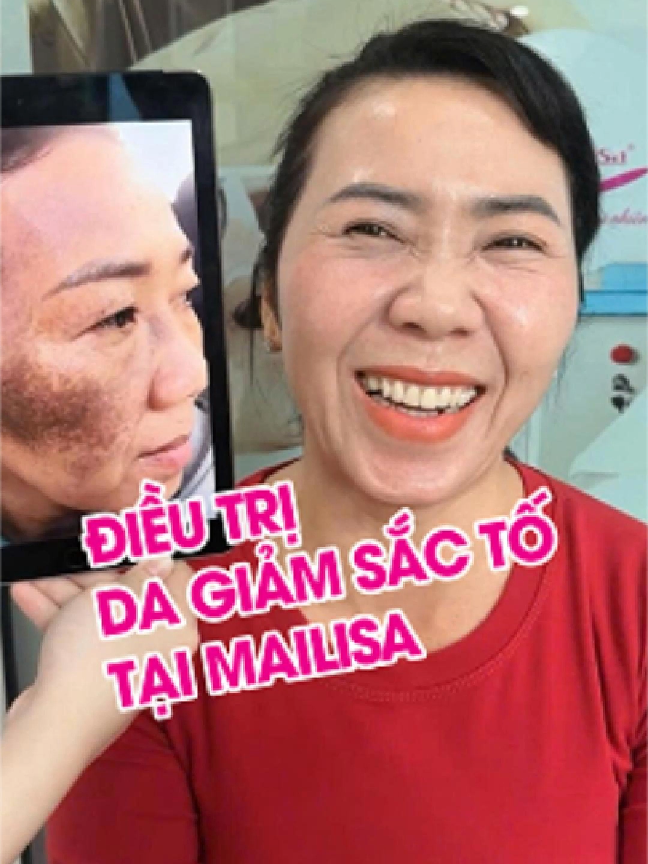 Review Loại Bỏ Bớt Sắc Tố Tại Mailisa. Chị khách hàng từng bị bớt sắc tố một bên mặt suốt mấy chục năm – sau hành trình ngắn tại Mailisa, chị đã tìm được làn da mong ước! Với nhiều người chỉ là video trước–sau, nhưng với người mang vết bớt từ nhỏ đó là cả hành trình lấy lại tự tin. Trước: bớt bẩm sinh bên má, sậm màu, không đều, đã trị nhiều nơi không hiệu quả, da yếu và nhạy cảm. Sau khi điều trị tại Mailisa: Vùng bớt mờ 80–90%, da sáng đều, khỏe mịn, chị tự tin hơn trong công việc và cuộc sống. Tại Mailisa, hành trình điều trị bớt sắc tố được thực hiện bằng sự kết hợp hoàn hảo giữa công nghệ độc quyền Whiteskin Spectra và mỹ phẩm Doctor Magic. Whiteskin Spectra 1064nm – chiếu trực tiếp vào vùng da bị bớt sắc tố, phá vỡ melanin thành hàng ngàn mảnh nhỏ li ti, giúp da sáng mịn và đều màu rõ rệt. Doctor Magic – hỗ trợ phục hồi, tái tạo và nuôi dưỡng làn da từ sâu bên trong, giúp hiệu quả duy trì lâu dài và bền vững. Dịch vụ làm đẹp da bằng công nghệ cao được giảm giá cụ thể như sau: xử lý nám, tàn nhang, đồi mồi chỉ với 800.000đ; cải thiện sẹo rỗ, da mụn chỉ với 800.000đ; bớt sắc tố chỉ với 1.200.000đ. Đặc biệt, ưu đãi sốc cho liệu trình DFT độc quyền giảm sâu từ 4.300.000đ chỉ còn 2.400.000đ. gồm: DFT làm mờ sắc tố – xử lý nám, sạm, đốm nâu, làm sáng đều màu da; DFT tái tạo da sẹo rỗ – làm đầy sẹo, kích thích collagen, thu nhỏ lỗ chân lông; DFT thanh lọc da mụn – làm sạch sâu, diệt khuẩn, giảm viêm, phục hồi làn da khỏe mạnh. Inbox ngay cho mailisa để được tư vấn miễn phí và nhận ưu đãi. #mailisa #sepemmailisa #botsacto#tmvmailisa #thammyvienmailisa #botsactobamsinh #dieutribotsacto #dieutribotsactomailisa #dieutrinam #photmailisa