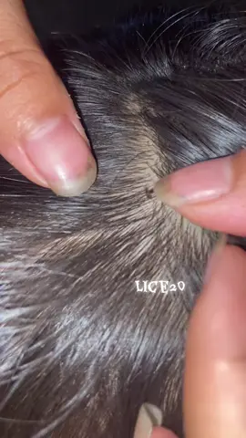 😱😱😱#omg #lice #liceremoval 
