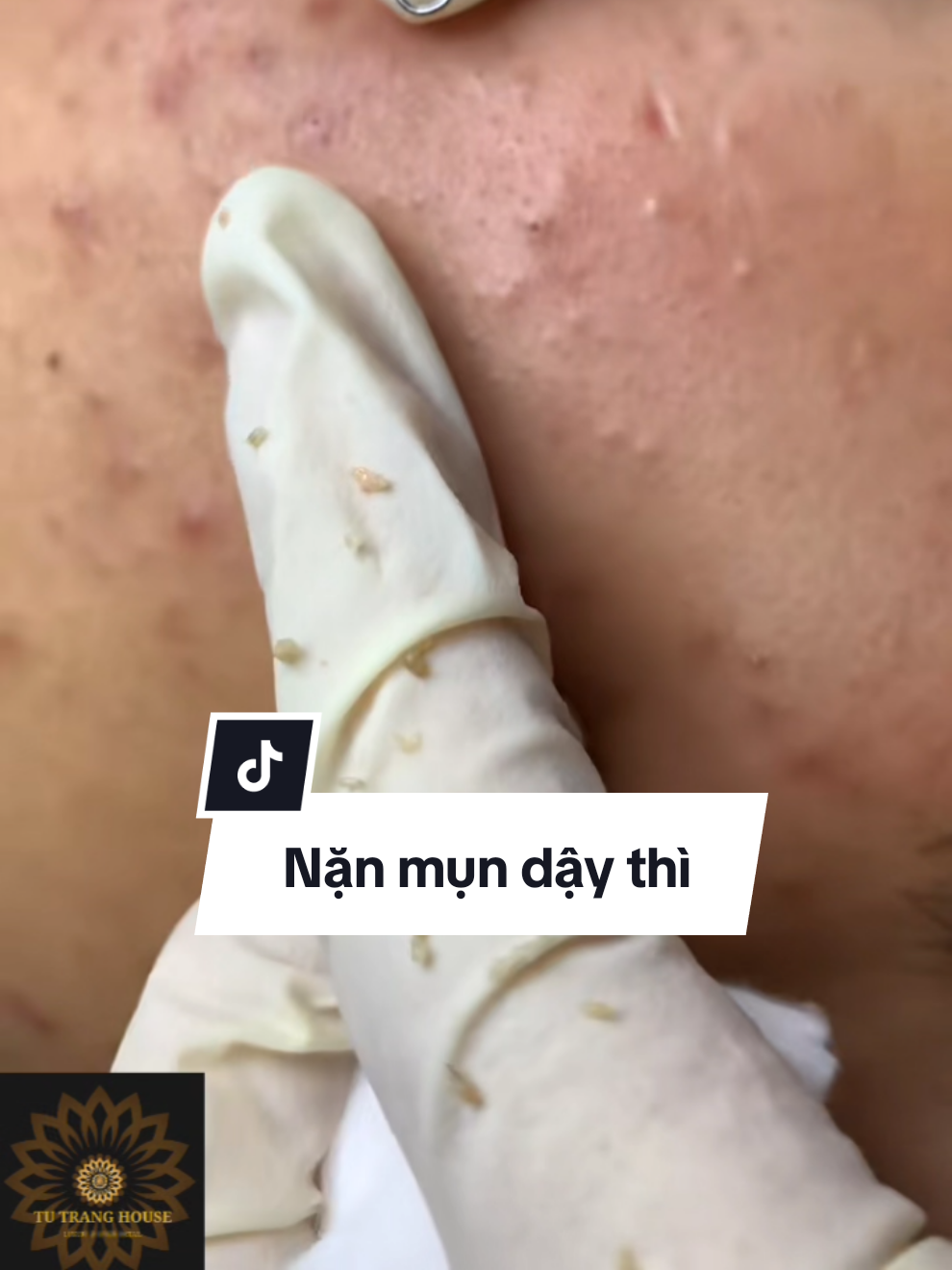 Nặn mụn dậy thì #lamdong #dalat #tutrangspa #nanmunbangtay #nanmun 