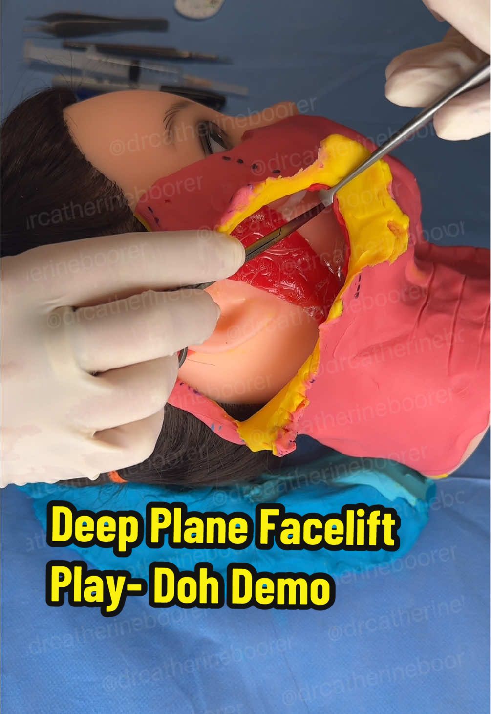 Why are deep plane facelifts so popular in 2025? Unlike traditional facelifts, deep plane facelifts lift both the skin and the underlying facial muscles, providing a more natural, long-lasting rejuvenation. They are designed to restore youthful contours without looking overly “done.” Recovery involves some swelling and bruising, which usually improves over the first few weeks, but healing times can vary between patients. A consultation with a qualified specialist is essential to discuss goals, realistic outcomes, and potential risks. 📌 Disclaimer: This post is for educational purposes only and does not replace a consultation with a qualified health professional. Individual results vary, and surgery carries risks. A thorough assessment and discussion of risks, benefits, and alternatives are essential before proceeding. Dr. Catherine Boorer | Board-Certified Specialist Plastic Surgeon MED0001167250