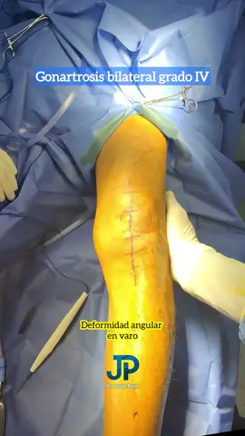 Un paciente más que recupera su calidad de vida. Realizamos artroplastia total posteroestabilizada de rodilla izquierda  en paciente con artrosis avanzada y deformidad angular en varo. #ProtesisdeRodilla #CirugiaDeRodilla #Ortopedista #artrosisderodilla #reemplazoarticular 