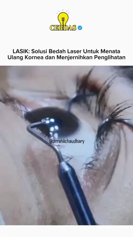 LASIK adalah prosedur bedah mata modern yang menggunakan sinar laser untuk memperbaiki penglihatan dengan cara membentuk ulang kornea, yaitu lapisan bening di bagian depan mata. Prosedur ini biasanya dilakukan pada orang yang memiliki rabun jauh, rabun dekat, atau astigmatisme. Dengan mengubah bentuk kornea secara presisi, cahaya dapat difokuskan dengan lebih tepat ke retina sehingga penglihatan menjadi lebih jelas. Selama tindakan, dokter membuka lapisan tipis pada permukaan kornea, lalu laser bekerja mengoreksi bagian dalamnya sesuai kebutuhan tiap pasien. Prosesnya cepat, umumnya tidak terasa sakit karena menggunakan obat tetes bius, dan flap kornea akan menutup kembali tanpa perlu jahitan. Banyak pasien mengalami penglihatan jauh lebih baik hanya dalam beberapa jam hingga hari setelah operasi. LASIK dapat mengurangi bahkan menghilangkan kebutuhan kacamata atau lensa kontak, meskipun hasilnya bisa berbeda untuk setiap orang. Faktor seperti ketebalan kornea, kondisi mata kering, atau usia tetap memengaruhi hasil jangka panjang. Meski begitu, bagi banyak orang, LASIK menjadi solusi efektif untuk mendapatkan penglihatan lebih tajam tanpa bantuan alat bantu. Sumber: American Academy of Ophthalmology (AAO)