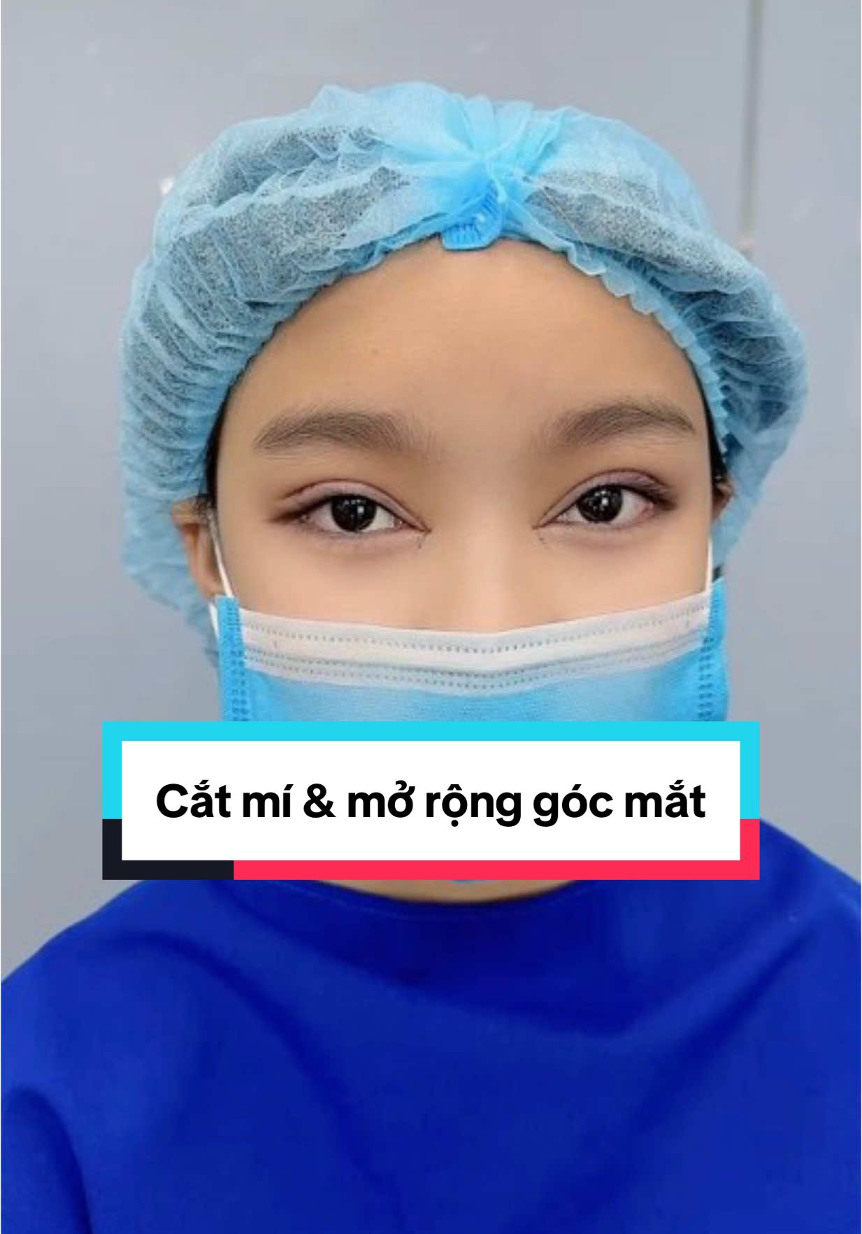 Combo cắt mí & mở rộng góc mắt 