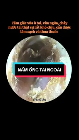 Nấm tai gây ngứa ngáy, rỉ nước dịch viêm, ù tai gây khó chịu, ảnh hưởng thính lực tai, cần được thăm khám và vệ sinh tai sạch kết hợp thuốc tai để lành khô tai trở lại! #bsductmh #bacsiductaimuihong #layraytai #layraytainoisoi #layraytaicucphe #earwax #earwaxremove #vesinhtaichuanykhoa #taimuihong #noisoitaimuihong #fungalotitisexterna #viemtai #namtai #phongkhamtaimuihonghcm #xuhuong #raytaitrenmangnhi #phongkhamtaimuihongvietducsg #quan12 #hocmon #cuchi #govap #tanbinh 