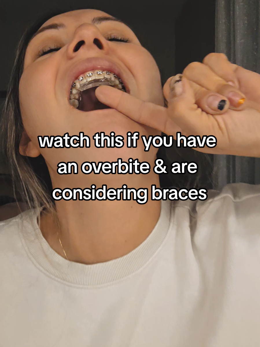 this is my personal experience with the bite block or bite plate, whatever it's called.. my braces journey 😅 #biteplate #braces #bracesafter30 #overbite #fyp 
