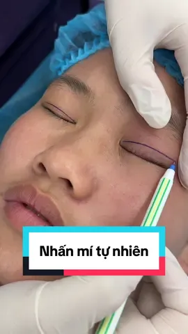 Mí xinh thay đổi cả khuôn mặt #nhanmi #nhấnmí #nhanmitunhien #catmi #cắtmí 