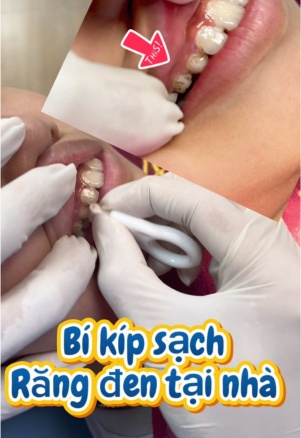 Bí kíp chăm con răng trắng xinh tại nhà cho các mom đây nhé ! Đơn giản- nhanh chóng- tiện lợi#saurang #mangbamcaorang #chamsocrangmieng #chamsocrangmiengchobe #xuhuong  @Mẹ Đậu Hóng Hớt 