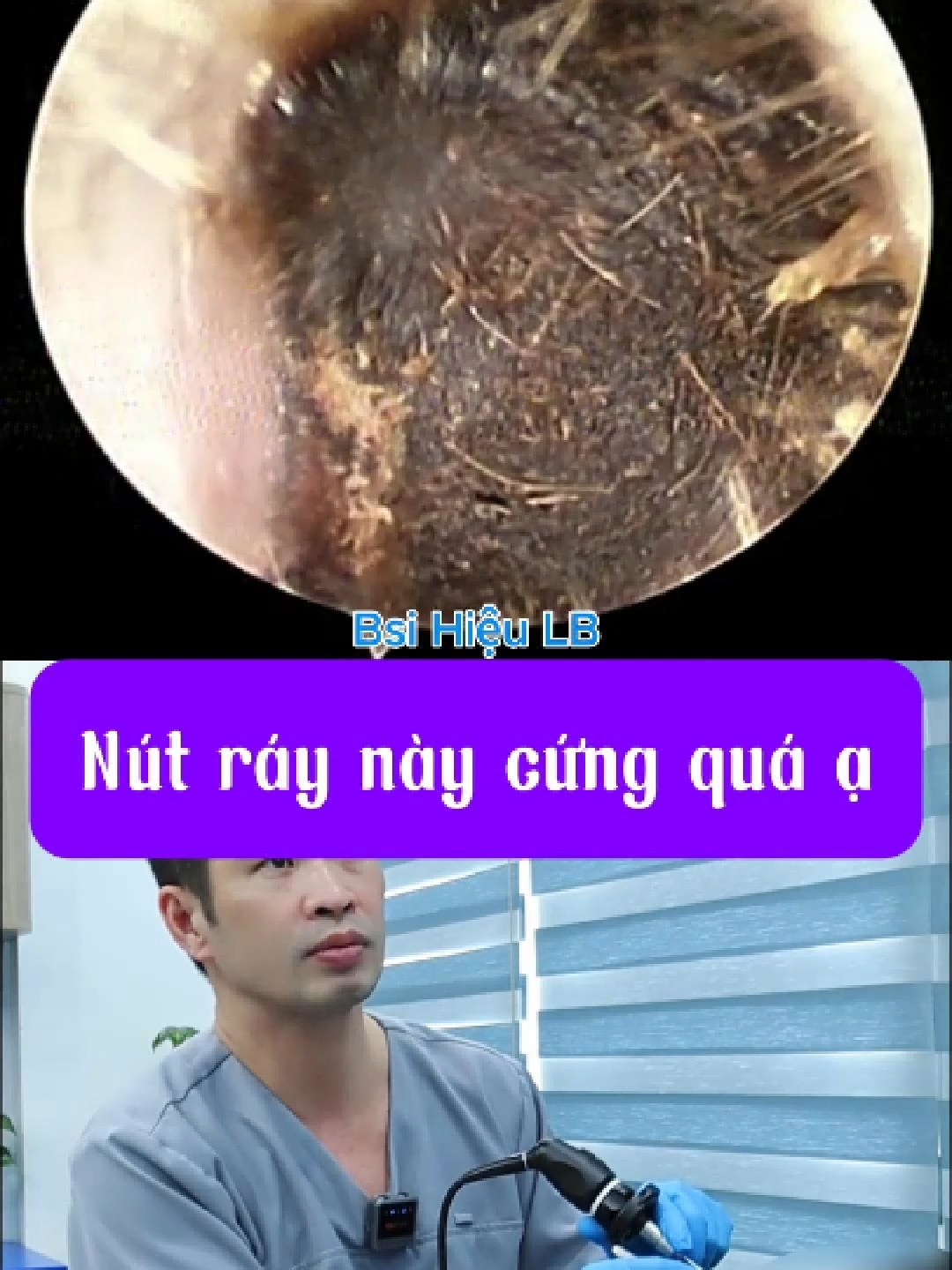 Cảm giác thật thoải mái và nhẹ người khi lấy được khối ráy này ra các bạn ạ #bacsihieulongbien #bacsihieutaimuihong #Bacsihieulongbien #layraytai #fyp #xuhuongtiktok