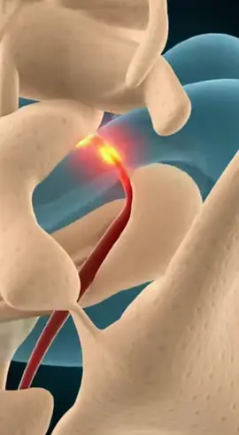 Don’t wait to address cervical pain—act early!#lumbarpain #health #lumbarpatch #lumbardischerniation #officeneckpain 
