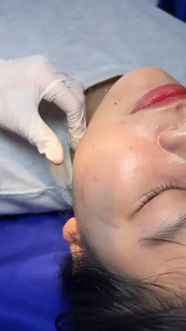 Tiêm thon gọn vline... Dành cho các bạn có hàm to, thô... Sau tiêm từ ngày thứ 7 sẽ thấy hàm mình nhỏ lại và gương mặt trở nên thon gọn rõ rệt... #tiemthongonham #tiembotoxtanan #fillerbottoxchuanykhoa #tiemvline #làmdep