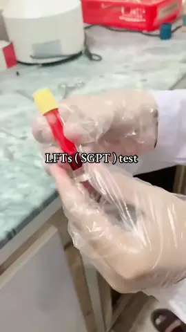 👉LFTs ( ALT/SGPT) Test Procedure 💞 #medicallabtechnologist #labtechnologist #professional #viraltiktok  @Lab Information @Al Saif Medical Lab @STANDARD MEDICAL LABORATORY 