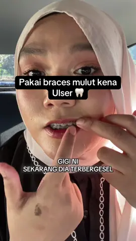 Pakai braces mulut kerap naik ulser,pakai wax ni je . #waxbraces #braces #bracesprogress 