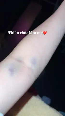 Tđtk trước khi test là có xin vía mà quên ko xin vía lấy máu không bị bầm 🥹 #landaulamme #fyp #viral #xh 