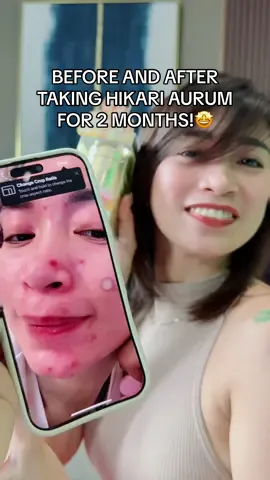 BEFORE AND AFTER TAKING HIKARI AURUM FOR 2 MONTHS!🤩 #hikariaurum #sacetylglutathione #HikariGlutathione 