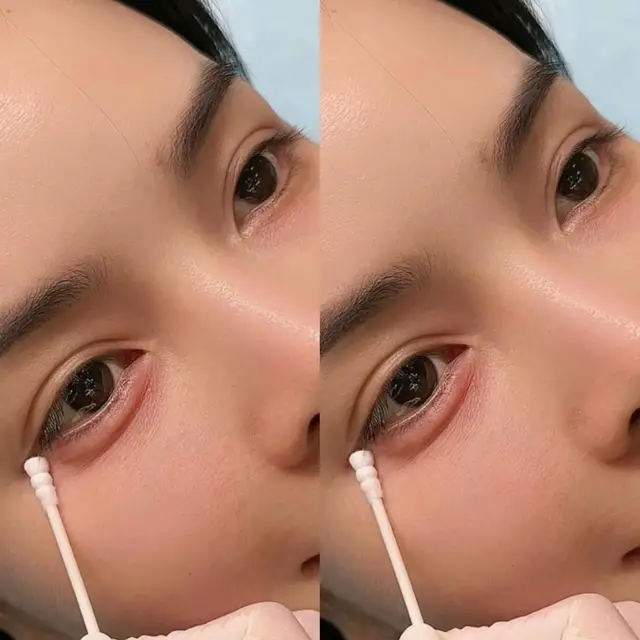 Tiêm bọng mắt cười
