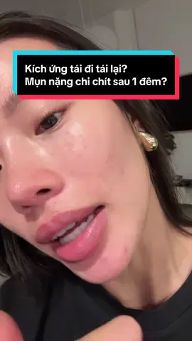 Bạn có bị “kích ứng” tái đi tái lại, mụn nặng đột ngột xuất hiện sau 1 đêm? Follow để mình chỉ cách thoát  tình trạng này nha 💕 #fyp #duongda #LuciaTrinh 