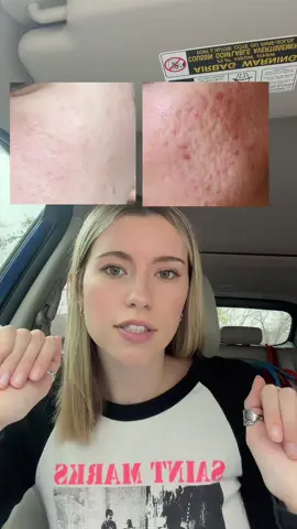 This stuff SAVED my skin! Microneedling results at home and it’s so affordable #microneedlingtherapy #microneedlingface #microneedling #microneedlingserum #skincare 