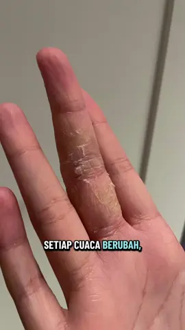 Cuaca berubah bikin kulit jadi kering bahkan sampe eksim 😭 Tapi semenjak aku pakai @Biotalk.id natural calendula salve ini, bersyukur banget eksim aku mulai memudar  Yang punya masalah kulit sama kaya aku, bisa nih cobain Biotalk Natural Calendula Salve ini ya  #eksim #byeeksim #eczema #cukupsatustep #biotalk 