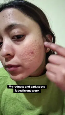 Darkspots gone in 7 days.. Yes best product for your acne scars and redness Just try it  Thank you @KSECRET GLOBAL #GOLDENGLOWCHALLENGE #ksecret #seoul1988 #darkspots 