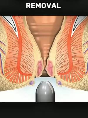 Ultimate Hemorrhoid Cream: Immediate Relief from Pain, Itching & Inflammation, Promotes Healing