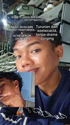 ini semua bukan soal siapa yang cepat, tapi konsisten. Thanks Azeclair acneno udah bantu aku buat sembuh #serumjerawat #azelaicacid #azeclairacneno #acneno #acne 