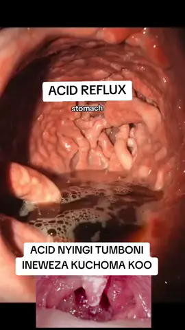 📌 Kwa wagonjwa wengi wa Acid Reflux (GERD) Reflux kali inayochoma koo kila siku inaongeza hatari ya kupata mabadiliko kwenye seli za koo kwa muda mrefu — ambayo yanaweza kupelekea kansa hasa ikiwa: Reflux imekuwepo kwa miaka mingi Kuna sauti kukwama mara kwa mara Koo kuungua kila siku Makhozi meupe yasiyokwisha Ukiwahi mapema unaweza kupona kabisa.,  #acidreflux #healtheducation #usa🇺🇸 #throatcancer #tanzaniatiktok 