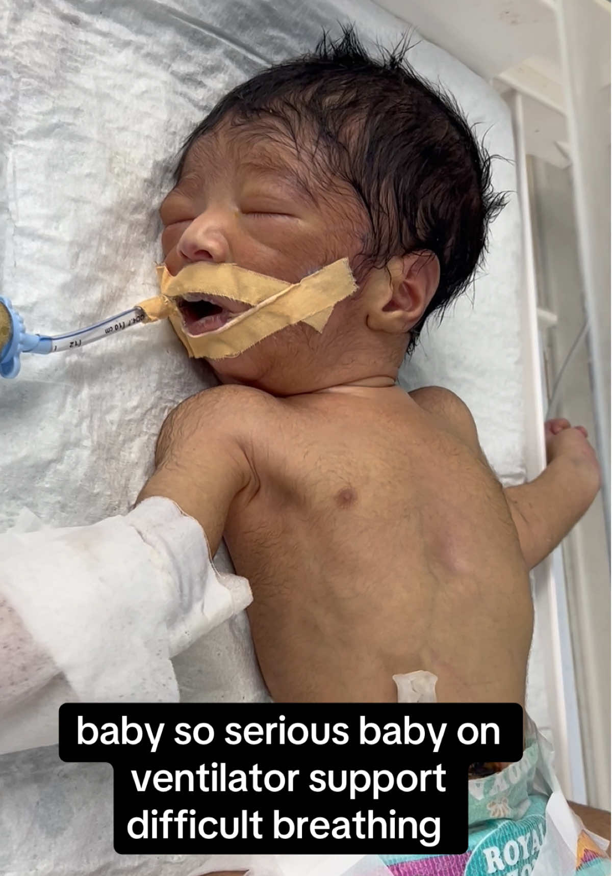 baby on ventilator support #difficulty #unfreezemyaccount #trendingvideos #newbron 