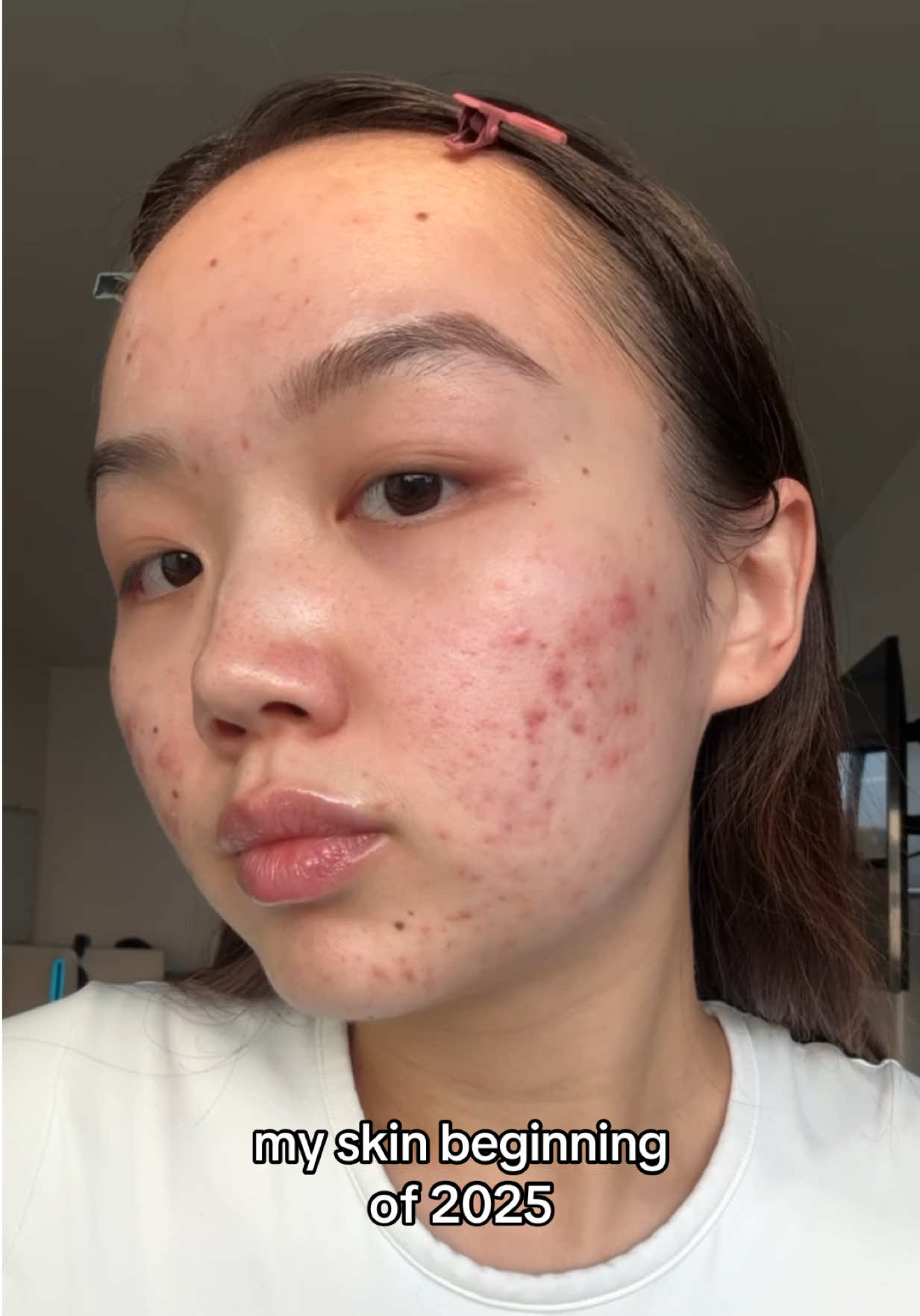 We’ve come a long way 🥹💪 #acne #acnejourney #clearskin 