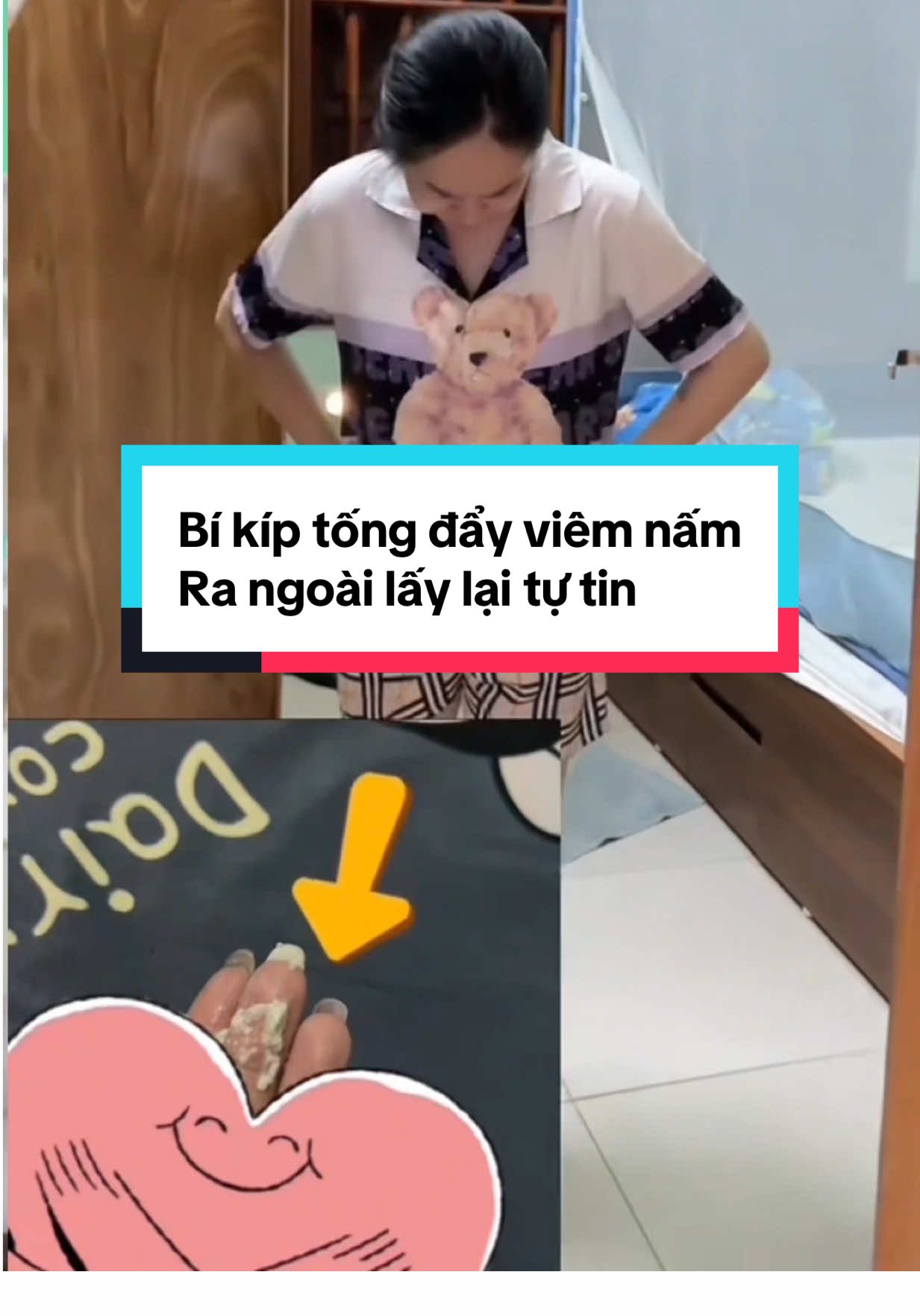 Bí kíp tống đẩy viêm nấm Ra ngoài lấy lại tự tin  #kemboithaomoc #kemthaomoc 