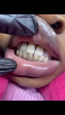 #scalingandpolishing #teethwhiteninginlagos #teethwhitening #oralcare #fyp 