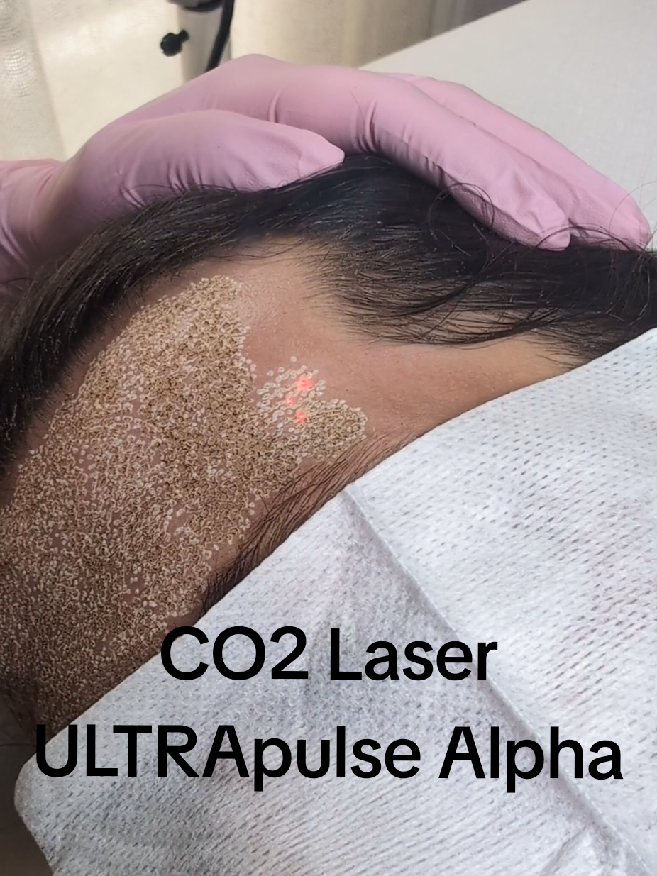 CO2 Laser at Skin Marceau Paris. Ultrapulse Alpha by Lumenis #laserco2 #co2laser #lasertreatment 