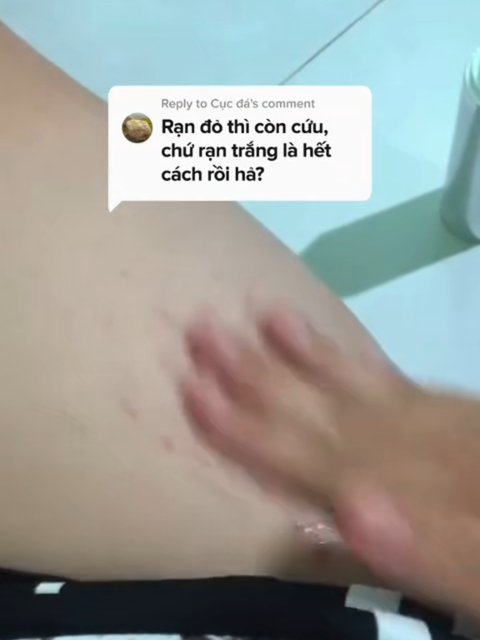 Kem Rạn Da – Da Mịn Màng Tự Nhiên #randa #antistretchmarkcream #antistretch #randasausinh #lamdepsausinh #atistretchmarkscream #skincare #lamdep