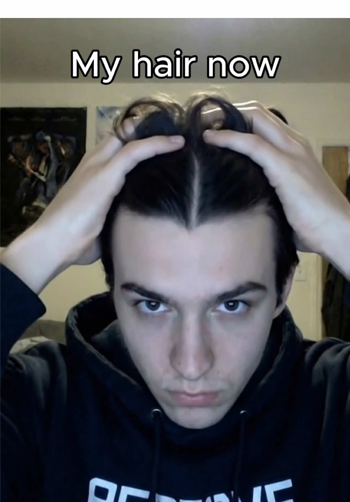 6 months later :)  #hairloss #men