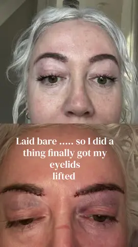 TRIGGER ❌ no make up no filter just real life me had a brow lift to improve my hooded eyes with the lovely miss Cindy IYKYK#foryoupage❤️❤️ #newyearnewme #viral #upperblepharopasty 