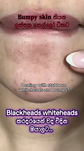 Blackheads whiteheads කරදරයෙන් වද විදින ඔයාලට..  0713416357 #dermacosalicylicacidserum #dermacosalicylicacidfaceserum