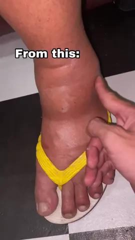 Hindi na nagtitiis si tatay sa sakit dulot ng pamamaga sa kanyang paa guys na tanggal na nga sakin Neto dahil sa Edema Relief Cream natin  Edema relief  pain relief  foot pain  Pamamaga  pamamaga sa paa  Leg Edema Relief Cream  Foot Edema Relief cream  Leg pain  Foot pain relief  Leg pain relief  pain reliever  Leg edema  Foot edema  #legedemareliefcream #edema #pamamaga #footpain #painreliever 