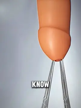 Circumcision Surgery Explained in Simple Words #circumcision #circumcisionprocedure #medicalanimation 