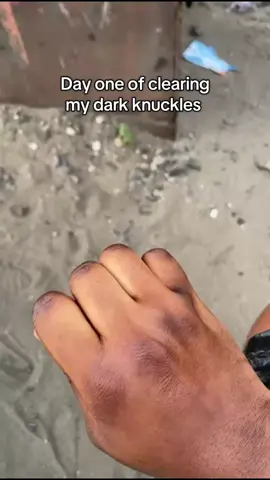 Short review on how I cleared my dark knuckles 💕🫶feel like everyone needs to see this #fyp 
