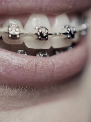 ¿Brackets en 2026?  Alinea tus dientes sin que nadie lo note con Moons. Agenda tu cita