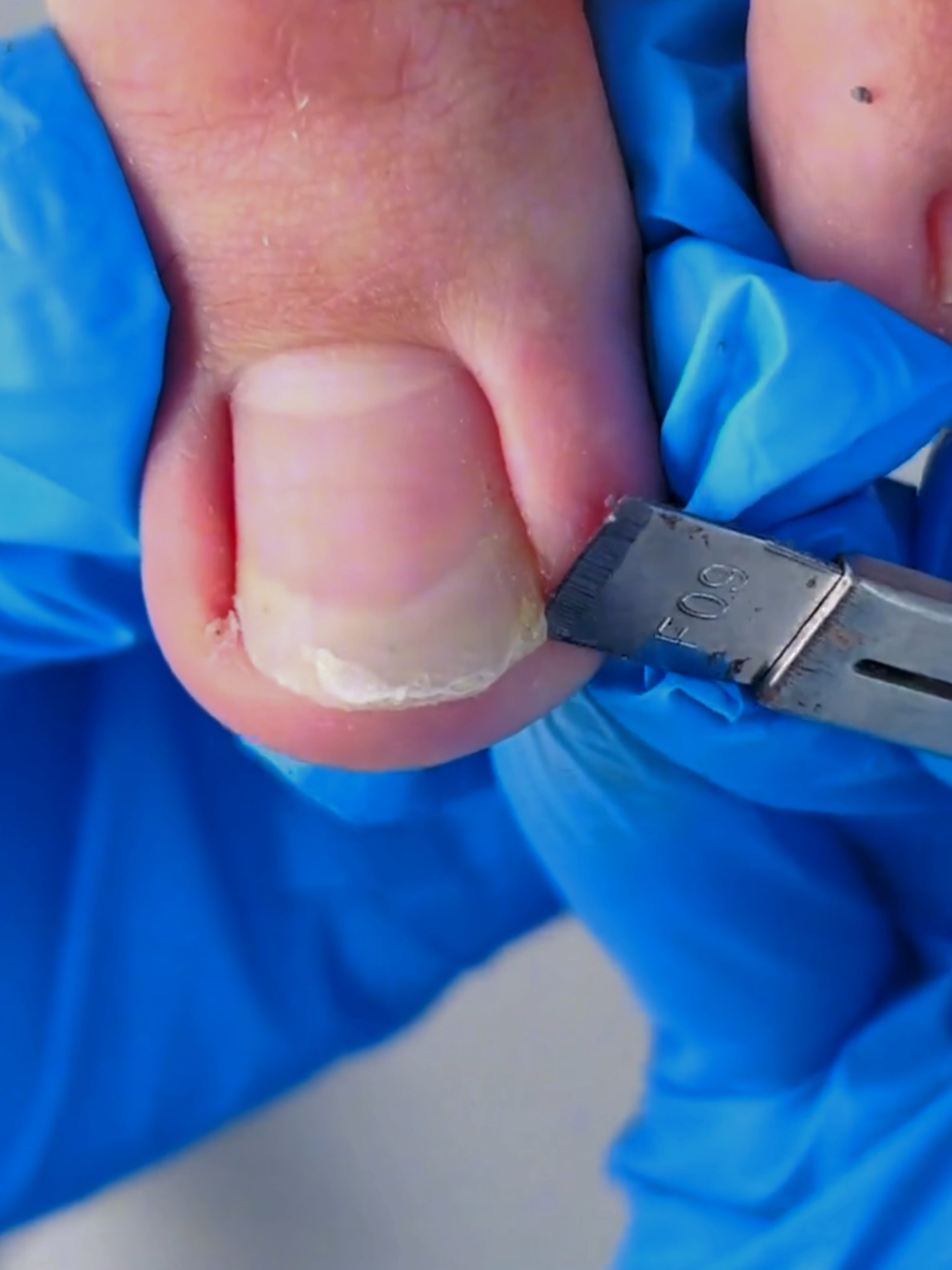 🦶 this toe begged for professional rescue 🦶 #trending #viral#podiatry #relief