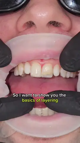 Composite confidence! Here's one in my series of 30 videos BASIC layering, use of OPAQUER and techniques #compositeveneers #compositebonding #cosmeticdentistry #smilemakeover #veneers 