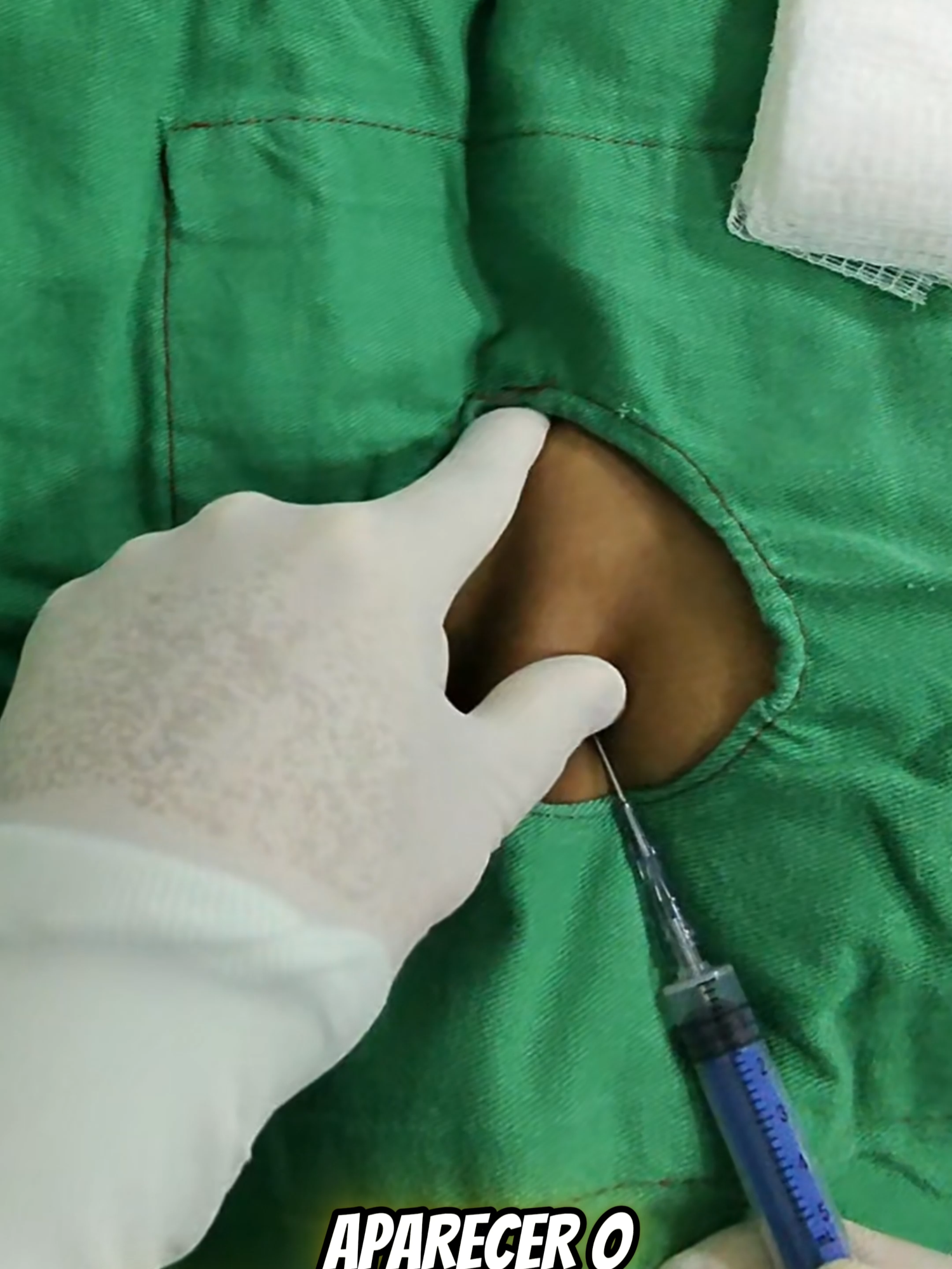 🔵 CVC em subclávia direita: técnica começa na anatomia. A veia subclávia é continuação da veia axilar a partir da borda lateral da primeira costela. Ela passa posteriormente à clavícula, anteriormente à artéria subclávia e superior à pleura e ao ápice pulmonar. Compreender essa relação tridimensional é fundamental para reduzir complicações como punção arterial e pneumotórax. Após a inserção pela técnica de Seldinger e posicionamento adequado da ponta na porção distal da veia cava superior, realizamos a fixação do cateter. A literatura atual não demonstra aumento consistente de infecção relacionado ao padrão específico de sutura, quando comparado a outras formas de fixação, desde que técnica asséptica e manejo adequado sejam mantidos. O que realmente impacta o risco infeccioso é: – Antissepsia adequada – Técnica de inserção – Curativo – Manipulação do cateter 📚 Referências: PMID: 31513685 PMID: 28902944 PMID: 31821240 PMID: 12233868 #UTI #MedicinaIntensiva #CVC #AcessoVenosoCentral #AnatomiaAplicada #InternoPadrao #Anatomania