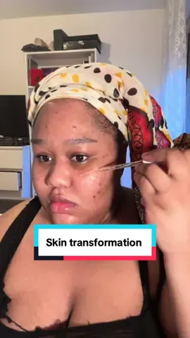 -5% yesstyle code: NAMJALYSSIA1 #acneproneskin @YesStyleInfluencers  @SKIN1004 US - Madagascar Centella Brightening Capsule Ampoule Jumbo #skin1004 #skintransformation #brighteningcapsuleampule #yesstyleinfluencer 