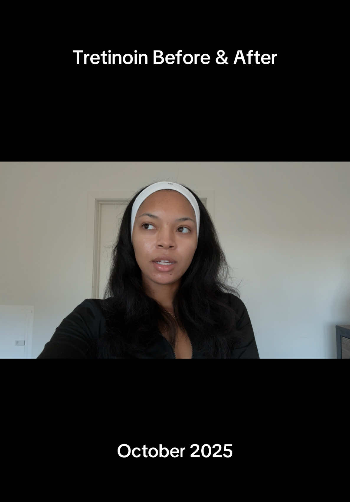 Replying to @tanyastevens I will say my skin came a longggg way before I even used tretinoin because I was disciplined with my skincare routine. Once I started using tretinoin it was more so to “perfect” and maintain. #tretinoin #tretinoinjourney #skincare #hyperpigmentation #acne 
