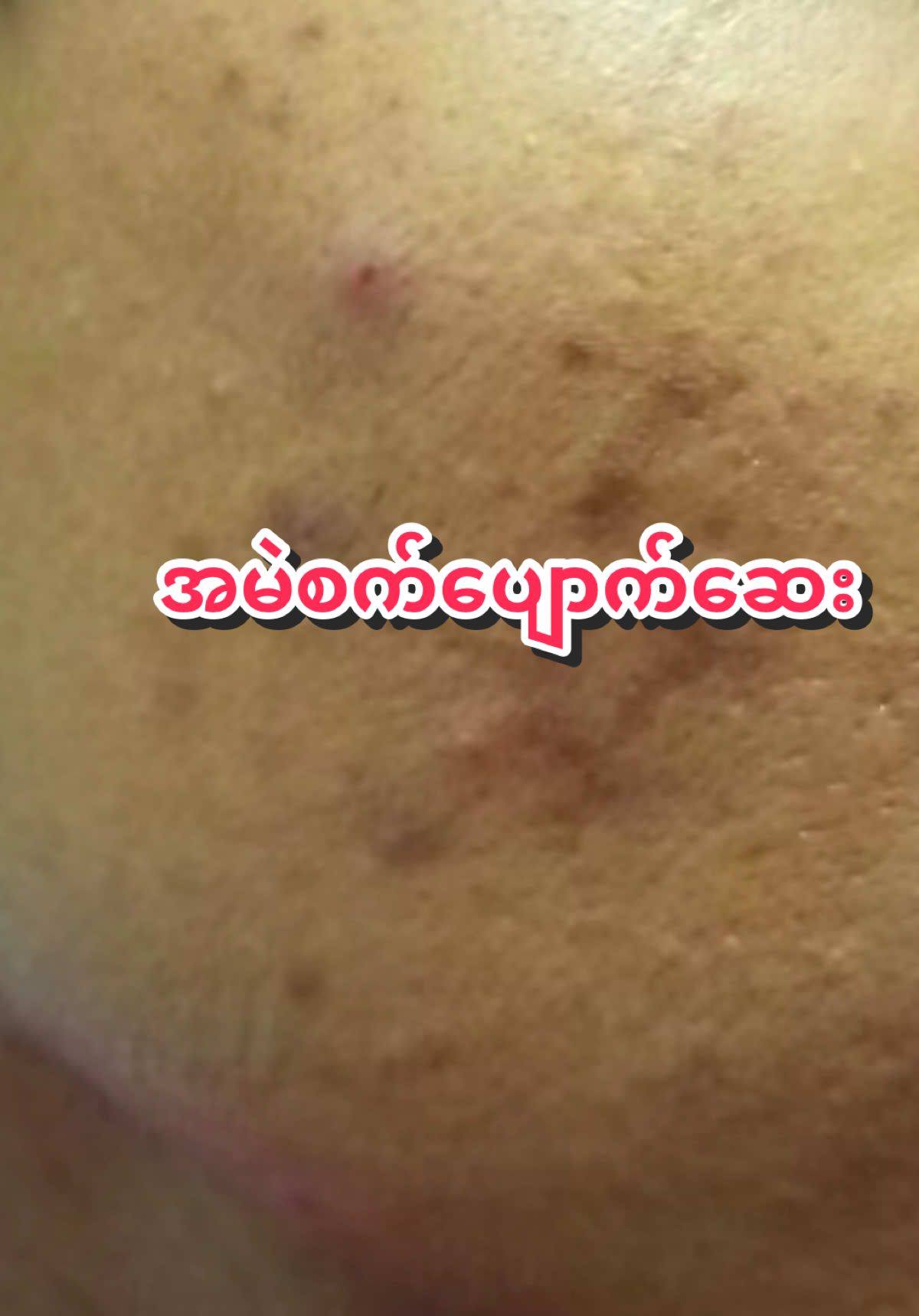 #အမဲစက်ပျောက်ချင်သူများ #အမဲစက်ပျောက်ဆေး 