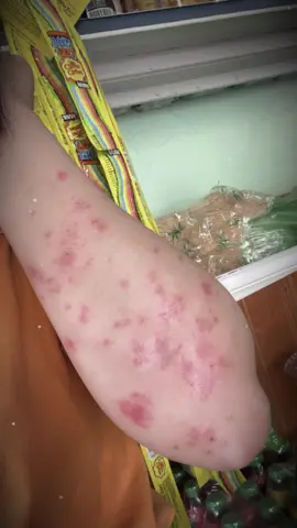 Đồng bệnh đã trải qua khoảng thời gian này như thế nào? Mình thì vừa đau, vừa nản, vừa buồn. Nhưng cố gắng sẽ vượt qua đc, mong rằng mọi ng đều vượt qua đc như mình. Căn bệnh khó diễn tả 🥲 #hanhtrinhkiemsoatvaynen #quyenbivaynen #trendingtiktok #xuhuongtiktok #2026 