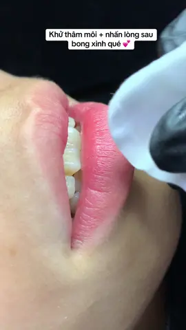 Bé nào muốn xử lí thâm nhưng vẫn có thêm độ hồng hào thì cứ chọn gói khử thâm + nhấn lòng là okila nhaa #phunxamphamminhnguyet #khuthammoicantho 