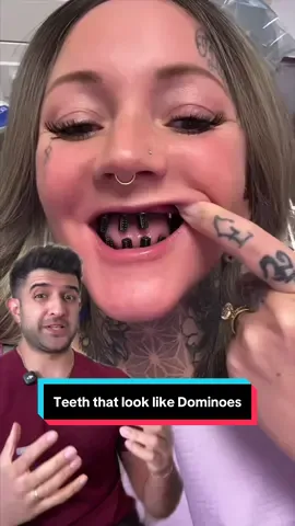 Have you ever seen teeth that look like domino’s before? #dentist #implant #domino #doctor #health VC:@denturegirly