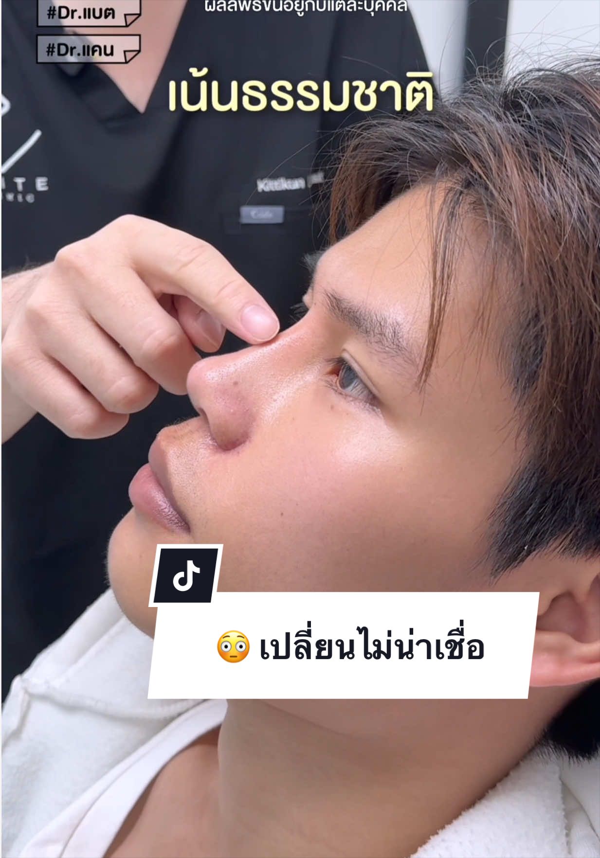 #เสริมจมูก #ตัดปีกจมูก หลังจากทำ 2 อย่าง หน้าเปลี่ยนมาก จมูกมีสันแล้ว ปีกเล็กลงด้วยดูดีขึ้นมากๆ @หมอแบต อีลิทคลินิก @หมอแคน อีลิทคลินิก 