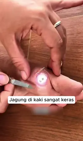 Masalah mata ikan? Coba plester ini! Efektif & gampang dipakai. Aku udah buktiin sendiri! 👍#SolusiMataIkan #PerawatanKaki #TipsSehat#ProdukRekomendasi #CaraAlami 